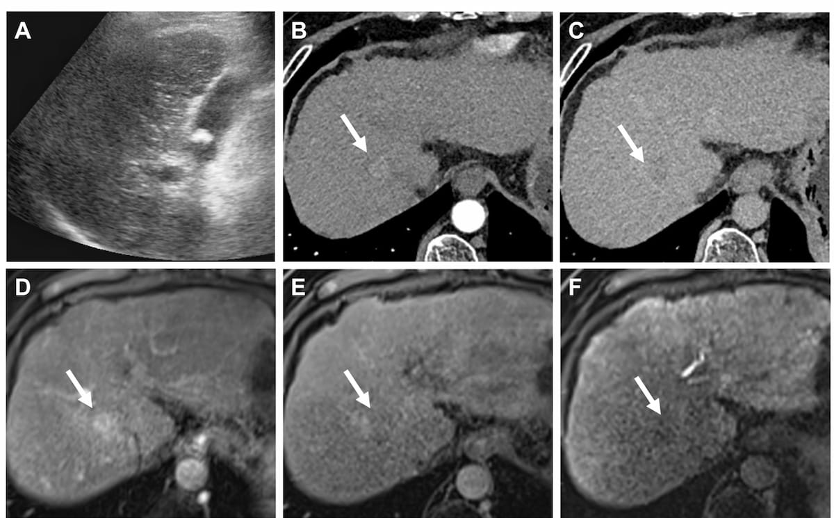 Multicenter Study Affirms Value of Updated AASLD Criteria for Surveillance of Hepatocellular Carcinoma