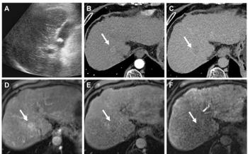 Multicenter Study Affirms Value of Updated AASLD Criteria for Surveillance of Hepatocellular Carcinoma