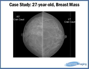 27-year-old, Breast Mass