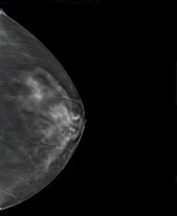 Mammography News: FDA Grants Expanded 510(k) Clearance for AI-Powered SmartMammo Dx DBT Software