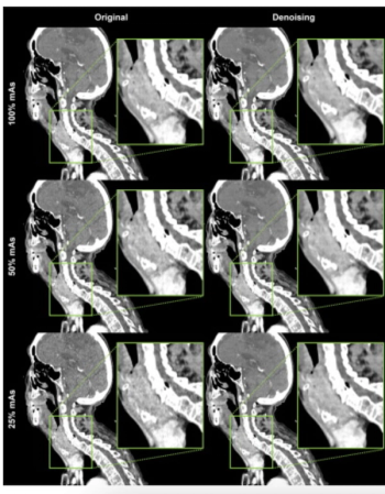 AI-Based Denoising for Neck CT May Facilitate Reductions in Radiation Dosing