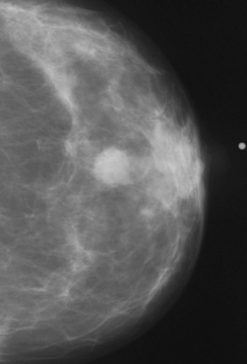 Study: Regular Mammography Screening Reduces Breast Cancer Mortality Risk by More Than 70 Percent