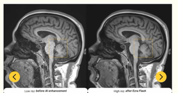 FDA Clears Updated Ezra Flash AI Software for MRI Scans