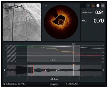 FDA Clears Optical Coherence Tomography System for AI-Enabled High-Resolution Imaging of Coronary Plaque
