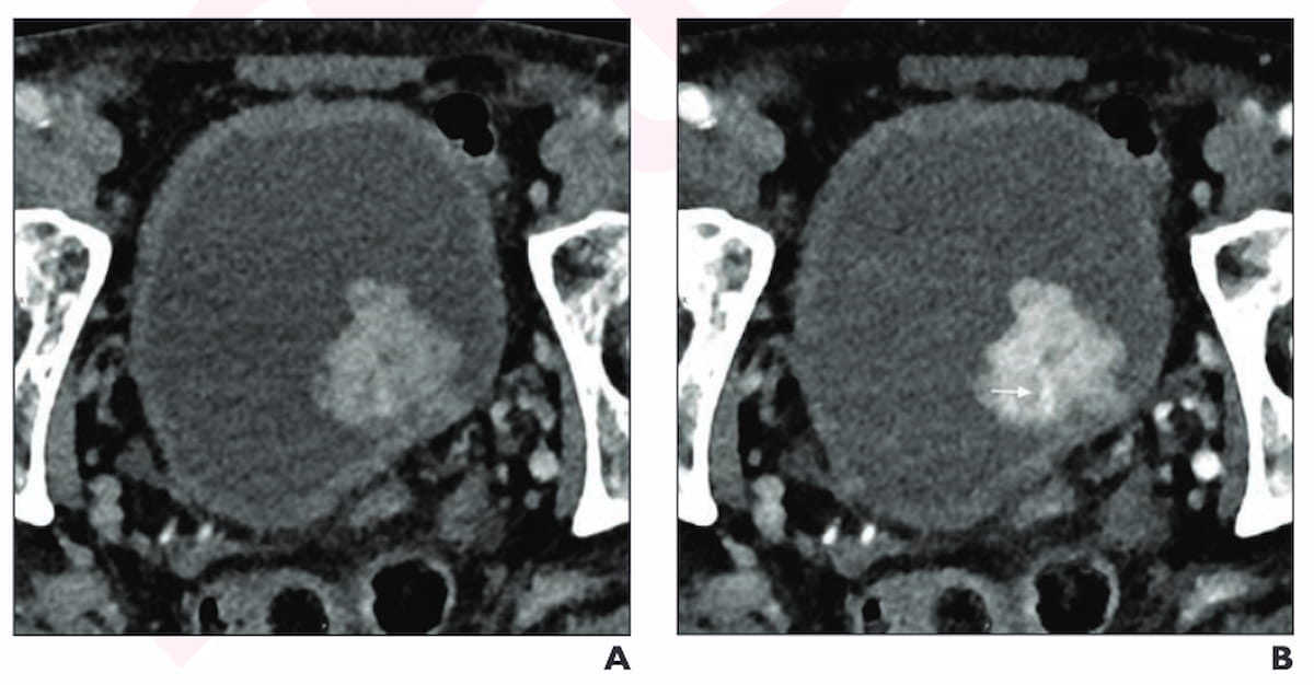 Could Photon Counting CT Enhance Local Staging of Bladder Cancer?