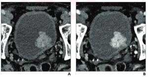 Could Photon Counting CT Enhance Local Staging of Bladder Cancer?