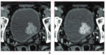 Could Photon Counting CT Enhance Local Staging of Bladder Cancer?