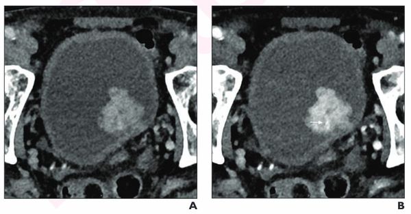 Could Photon Counting CT Enhance Local Staging of Bladder Cancer?