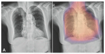 Can AI Facilitate Improved Dual-Energy X-Ray Screening for Patients at High Risk of Osteoporosis?