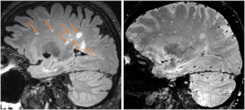 Can a Six-Minute MRI Facilitate Detection of Multiple Sclerosis?