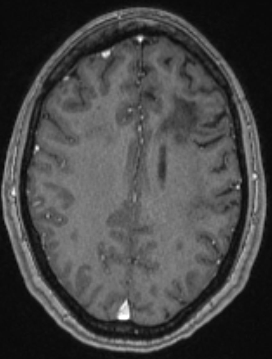 Image IQ Quiz: 36-Year-Old Patient with Six-Month History of 'Brain Fog'