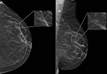 Study of Mammography AI Software Notes 50 Percent Higher Likelihood of False-Positive Results for Black Women