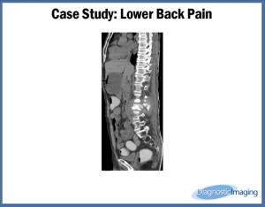 Lower Back Pain