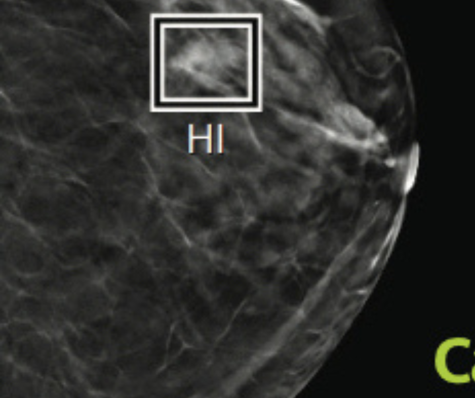 DeepHealth Gets FDA Nod for AI Mammography Software That Assesses Breast Density