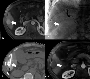 What is the Best HCC Staging System for People Being Treated with Transarterial Chemoembolization (TACE)?