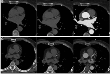 Could Virtual Non-Contrast Images from Photon-Counting CT Reduce Radiation Dosing with CCTA?