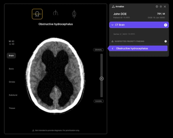 CMS Approves NTAP Reimbursement for CT-Based AI Triage Software for Obstructive Hydrocephalus