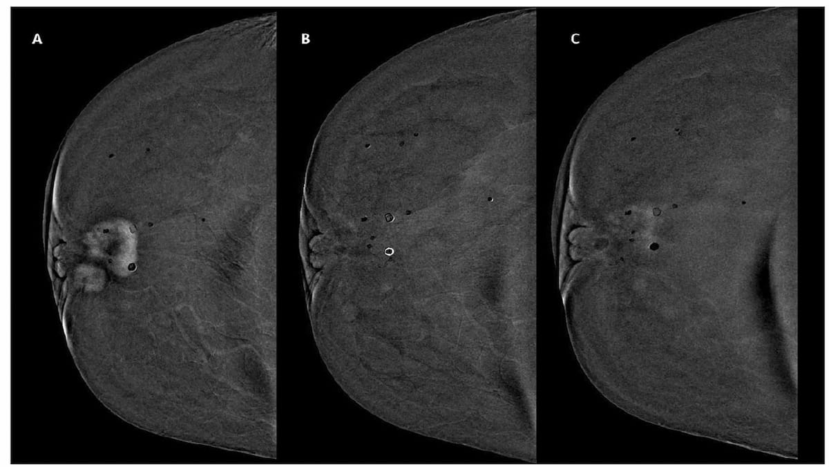 Post-NAC Contrast-Enhanced Mammography: Is Delayed Image Acquisition the Best Way to Assess for Residual Disease?