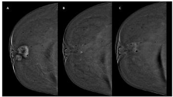 Post-NAC Contrast-Enhanced Mammography: Is Delayed Image Acquisition the Best Way to Assess for Residual Disease?