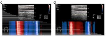 Ultrafast Ultrasound Study Shows Link Between Carotid Stiffening and Cardiovascular Risks in Younger Populations