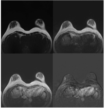 Breast MRI and Dense Breasts: A Closer Look at Early Findings from a New Prospective Trial 