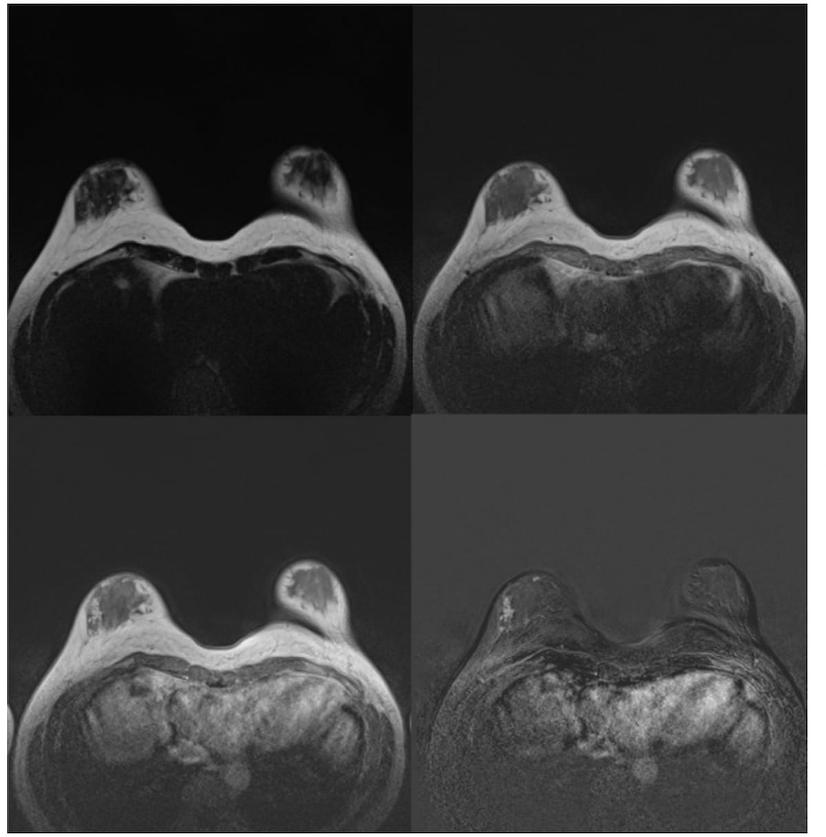 Breast MRI and Dense Breasts: A Closer Look at Early Findings from a ...
