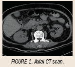 Emphysematous pyelitis