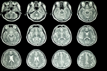 AI Software for Brain MRI Gets Expanded FDA Clearance for Multiple Sclerosis Assessment