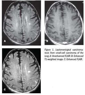Contrast FLAIR tops FLAIR and contrast T1-weighted images