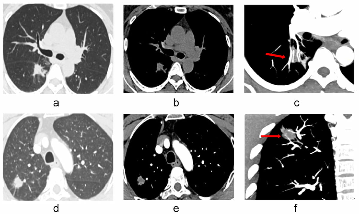 Study Shows Merits of CT Vascular Sign for Differentiating Solid Pulmonary Nodules