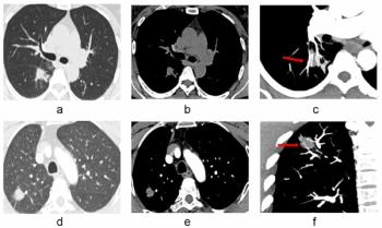 Study Shows Merits of CT Vascular Sign for Differentiating Solid Pulmonary Nodules