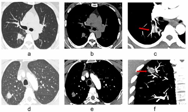 Study Shows Merits of CT Vascular Sign for Differentiating Solid Pulmonary Nodules