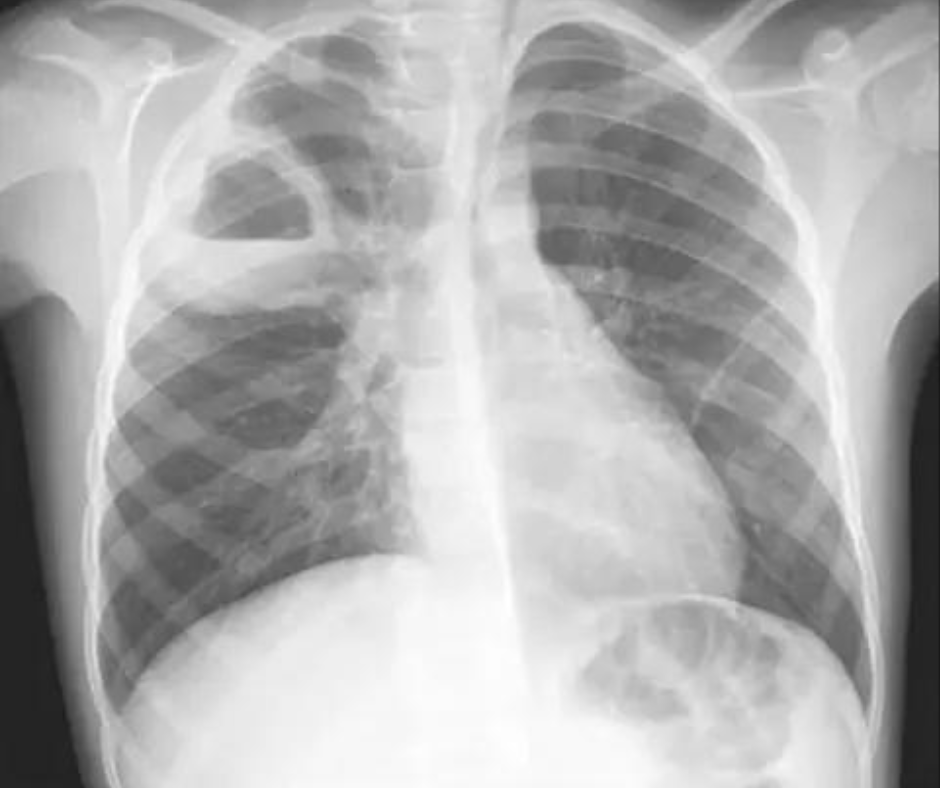 Image iQ Quiz: 65-Year-Old Patient with Pneumonia and Repeat Hospital Admissions