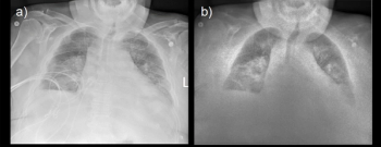 Can Portable Dual-Energy X-Ray be a Viable Alternative to CT in the ICU?