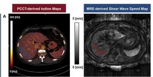 Could Quantification of Extracellular Volume Fraction with PCCT Be a Viable Alternative for Staging Liver Fibrosis?