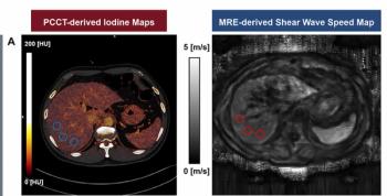 Could Quantification of Extracellular Volume Fraction with PCCT Be a Viable Alternative for Staging Liver Fibrosis?