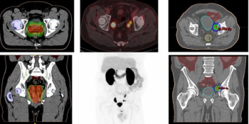 SNMMI: PSMA-18F DCFPyL Changes Treatment for Prostate Cancer Recurrence in Significant Number of Patients with Low PSAs