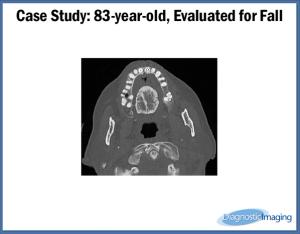 83-year-old, Evaluated for Fall
