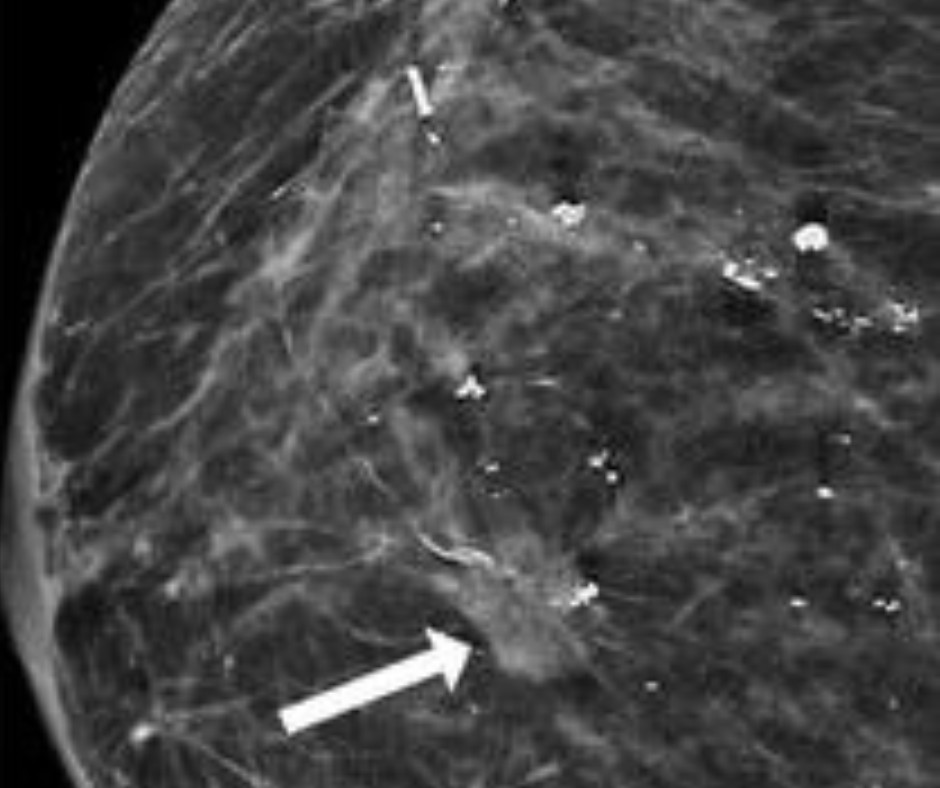 What A New Mammography Study Reveals About Surveillance Imaging In ...