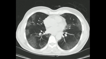 What a New Meta-Analysis Reveals About CT Diagnosis of COVID-19