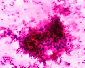 Emerging PET Agent Garners FDA Fast Track Designation for Clear Cell Renal Cell Carcinoma 