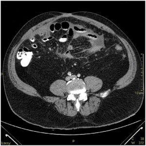 Primary Peritoneal Mesothelioma