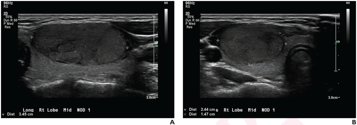 Thyroid Nodule Ultrasound