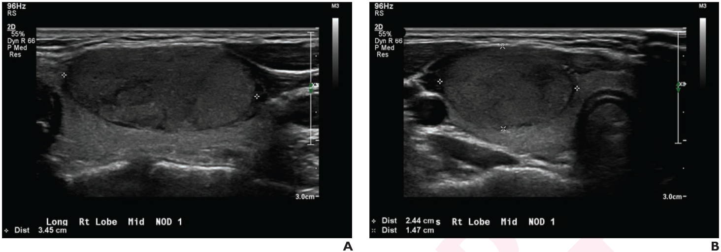 Pediatric Thyroid Nodules on Ultrasound: Deep Learning Model and TI-RADS Show Higher Sensitivity than Radiologist Assessment
