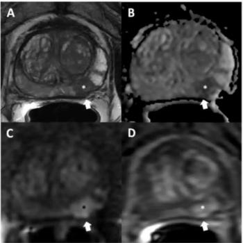 Meta-Analysis Shows Prognostic Impact of Prostate MRI Prior to Radical Prostatectomy