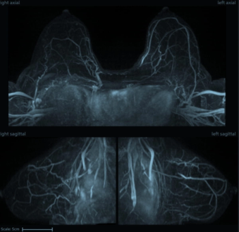 Emerging AI Algorithm Shows Promise for Abbreviated Breast MRI in Multicenter Study