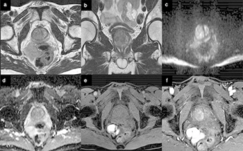 Seven Takeaways from Recent Review on Prostate MRI Imaging Quality