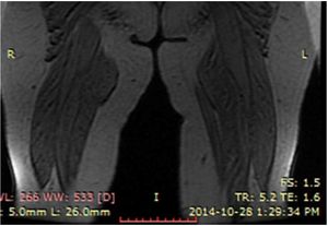 Image IQ: 74-year-old Female, Soft Swellings Around Knees, Thighs