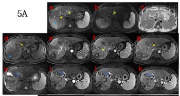 Key MRI Findings Predictive of Treatment Response for Unresectable Hepatocellular Carcinoma