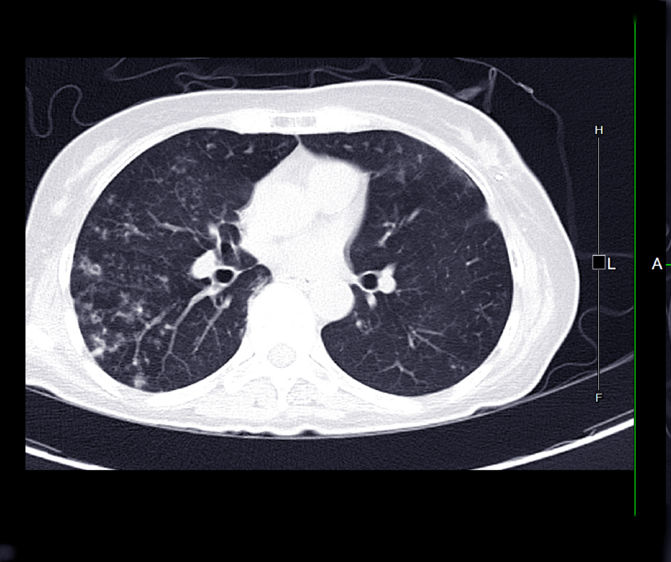 Lung Cancer Screening Study Says Significant Disparities Persist Despite Expanded Eligibility